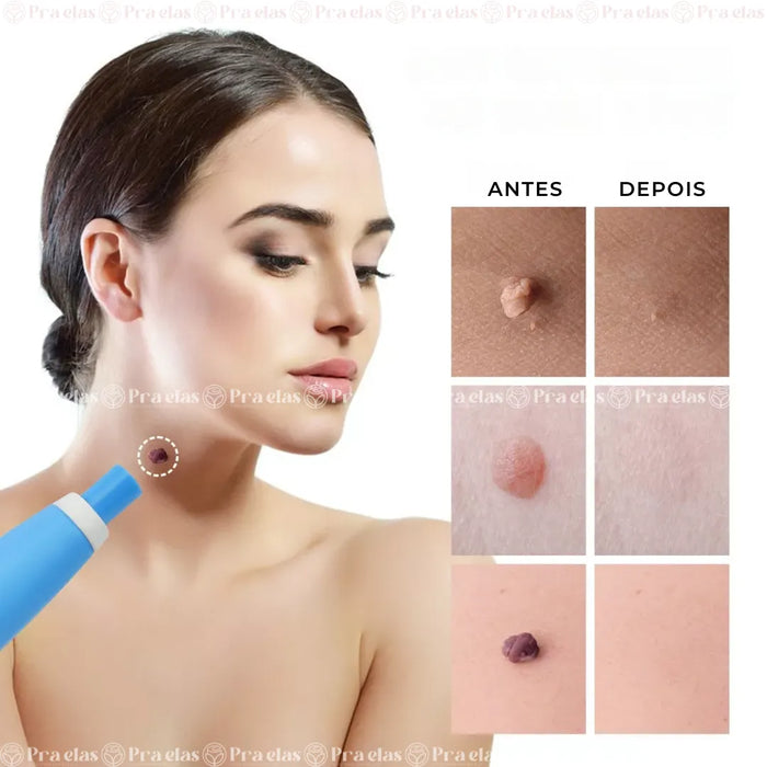 Caneta Removedora de Verrugas (acrocórdons)
