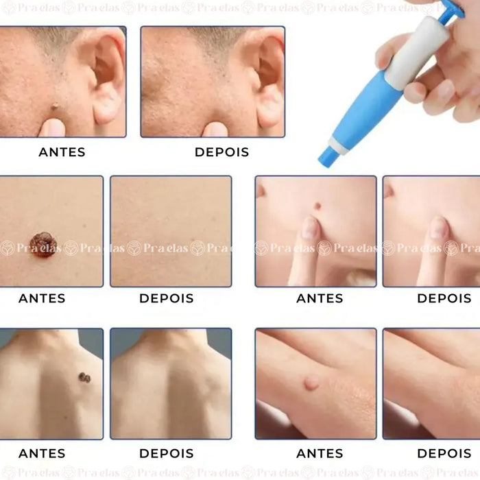 Caneta Removedora de Verrugas (acrocórdons)