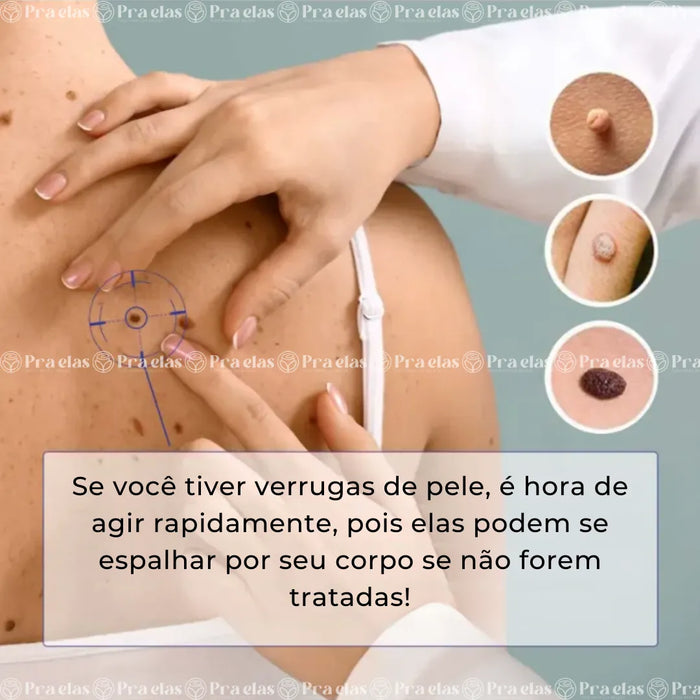 Caneta Removedora de Verrugas (acrocórdons)